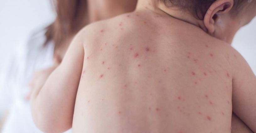 水痘疫苗 Varicella Vaccine --Yeung Ho Hong, 楊浩康